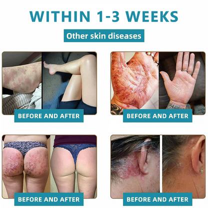 Total Skin Confidence Starts Here💫𝗞ı𝗱s𝗻𝗲𝗲𝗱® 𝗡𝗼𝗻-𝗜𝗻𝘃𝗮𝘀𝗶𝘃𝗲 𝗠𝗼𝗜𝗲 𝗮𝗻𝗱 𝗪𝗮𝗿𝘁 𝗥𝗲𝗺𝗼𝘃𝗮𝗜 𝗜𝗮𝘀𝗲𝗿 𝗣𝗲𝗻👨‍⚕️