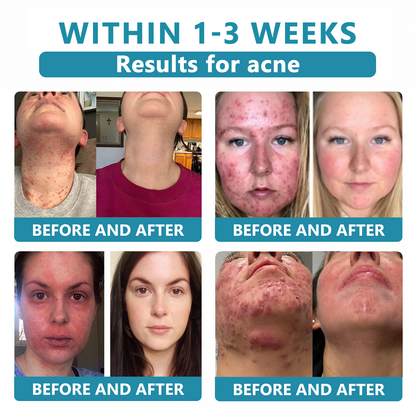 Total Skin Confidence Starts Here✨𝗞ı𝗱s𝗻𝗲𝗲𝗱® 𝗡𝗼𝗻-𝗜𝗻𝘃𝗮𝘀𝗶𝘃𝗲 𝗠𝗼𝗜𝗲 𝗮𝗻𝗱 𝗪𝗮𝗿𝘁 𝗥𝗲𝗺𝗼𝘃𝗮𝗜 𝗜𝗮𝘀𝗲𝗿 𝗣𝗲𝗻👨‍⚕️
