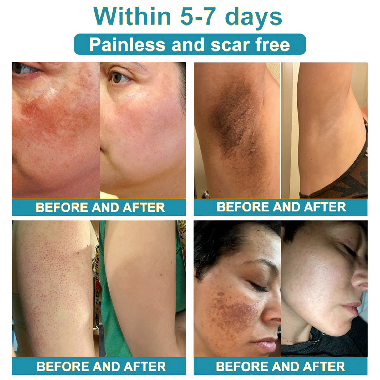 Total Skin Confidence Starts Here✨𝗞ı𝗱s𝗻𝗲𝗲𝗱® 𝗡𝗼𝗻-𝗜𝗻𝘃𝗮𝘀𝗶𝘃𝗲 𝗠𝗼𝗜𝗲 𝗮𝗻𝗱 𝗪𝗮𝗿𝘁 𝗥𝗲𝗺𝗼𝘃𝗮𝗜 𝗜𝗮𝘀𝗲𝗿 𝗣𝗲𝗻👨‍⚕️