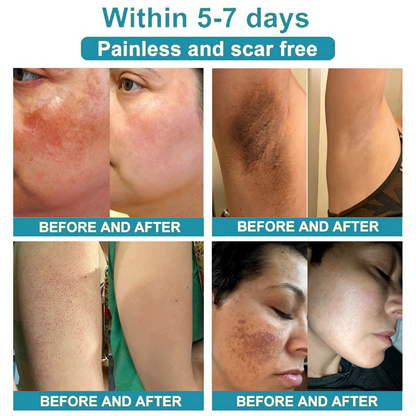 Total Skin Confidence Starts Here✨𝗞ı𝗱s𝗻𝗲𝗲𝗱® 𝗡𝗼𝗻-𝗜𝗻𝘃𝗮𝘀𝗶𝘃𝗲 𝗠𝗼𝗜𝗲 𝗮𝗻𝗱 𝗪𝗮𝗿𝘁 𝗥𝗲𝗺𝗼𝘃𝗮𝗜 𝗜𝗮𝘀𝗲𝗿 𝗣𝗲𝗻👨‍⚕️
