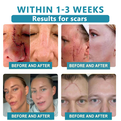 Total Skin Confidence Starts Here✨𝗞ı𝗱s𝗻𝗲𝗲𝗱® 𝗡𝗼𝗻-𝗜𝗻𝘃𝗮𝘀𝗶𝘃𝗲 𝗠𝗼𝗜𝗲 𝗮𝗻𝗱 𝗪𝗮𝗿𝘁 𝗥𝗲𝗺𝗼𝘃𝗮𝗜 𝗜𝗮𝘀𝗲𝗿 𝗣𝗲𝗻👨‍⚕️