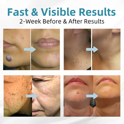 Total Skin Confidence Starts Here💫𝗞ı𝗱s𝗻𝗲𝗲𝗱® 𝗡𝗼𝗻-𝗜𝗻𝘃𝗮𝘀𝗶𝘃𝗲 𝗠𝗼𝗜𝗲 𝗮𝗻𝗱 𝗪𝗮𝗿𝘁 𝗥𝗲𝗺𝗼𝘃𝗮𝗜 𝗜𝗮𝘀𝗲𝗿 𝗣𝗲𝗻👨‍⚕️