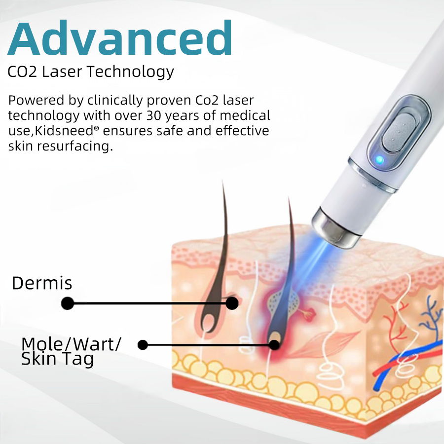 Total Skin Confidence Starts Here💫𝗞ı𝗱s𝗻𝗲𝗲𝗱® 𝗡𝗼𝗻-𝗜𝗻𝘃𝗮𝘀𝗶𝘃𝗲 𝗠𝗼𝗜𝗲 𝗮𝗻𝗱 𝗪𝗮𝗿𝘁 𝗥𝗲𝗺𝗼𝘃𝗮𝗜 𝗜𝗮𝘀𝗲𝗿 𝗣𝗲𝗻👨‍⚕️