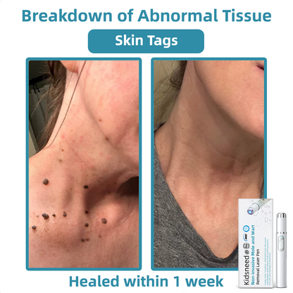 Total Skin Confidence Starts Here💫𝗞ı𝗱s𝗻𝗲𝗲𝗱® 𝗡𝗼𝗻-𝗜𝗻𝘃𝗮𝘀𝗶𝘃𝗲 𝗠𝗼𝗜𝗲 𝗮𝗻𝗱 𝗪𝗮𝗿𝘁 𝗥𝗲𝗺𝗼𝘃𝗮𝗜 𝗜𝗮𝘀𝗲𝗿 𝗣𝗲𝗻👨‍⚕️