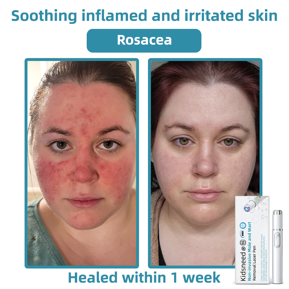 Total Skin Confidence Starts Here💫𝗞ı𝗱s𝗻𝗲𝗲𝗱® 𝗡𝗼𝗻-𝗜𝗻𝘃𝗮𝘀𝗶𝘃𝗲 𝗠𝗼𝗜𝗲 𝗮𝗻𝗱 𝗪𝗮𝗿𝘁 𝗥𝗲𝗺𝗼𝘃𝗮𝗜 𝗜𝗮𝘀𝗲𝗿 𝗣𝗲𝗻👨‍⚕️