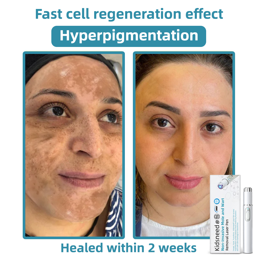 Total Skin Confidence Starts Here✨𝗞ı𝗱s𝗻𝗲𝗲𝗱® 𝗡𝗼𝗻-𝗜𝗻𝘃𝗮𝘀𝗶𝘃𝗲 𝗠𝗼𝗜𝗲 𝗮𝗻𝗱 𝗪𝗮𝗿𝘁 𝗥𝗲𝗺𝗼𝘃𝗮𝗜 𝗜𝗮𝘀𝗲𝗿 𝗣𝗲𝗻👨‍⚕️