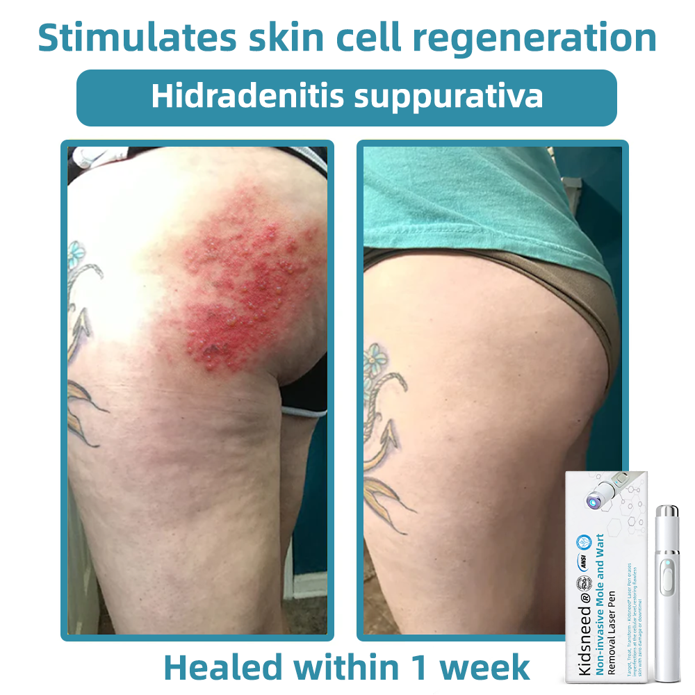 Total Skin Confidence Starts Here💫𝗞ı𝗱s𝗻𝗲𝗲𝗱® 𝗡𝗼𝗻-𝗜𝗻𝘃𝗮𝘀𝗶𝘃𝗲 𝗠𝗼𝗜𝗲 𝗮𝗻𝗱 𝗪𝗮𝗿𝘁 𝗥𝗲𝗺𝗼𝘃𝗮𝗜 𝗜𝗮𝘀𝗲𝗿 𝗣𝗲𝗻👨‍⚕️